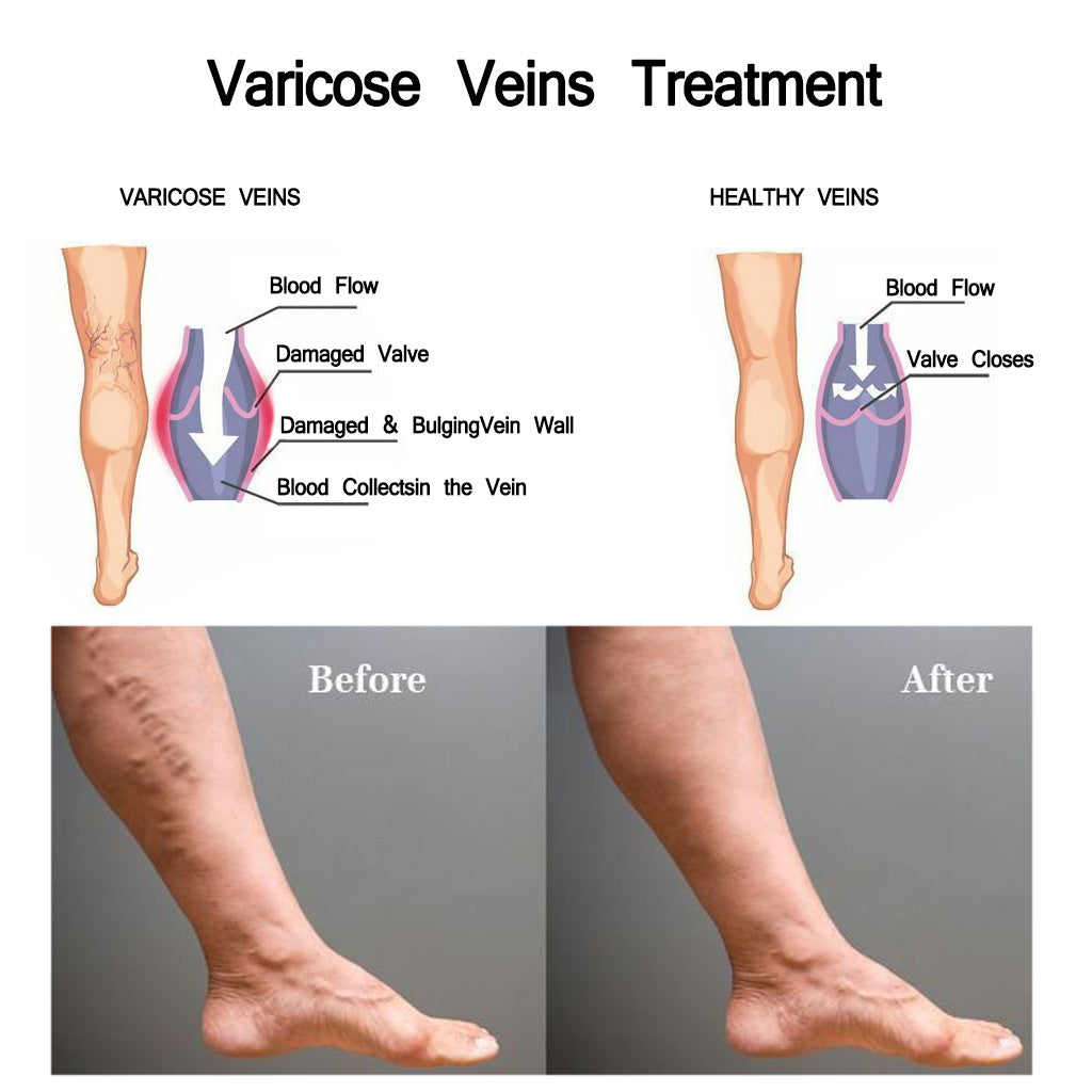 JAYSUNG Varicose Vein Cream - Buy 3, Pay For 2