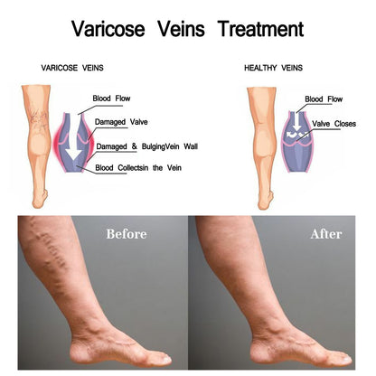 JAYSUNG Varicose Vein Cream - Buy 3, Pay For 2