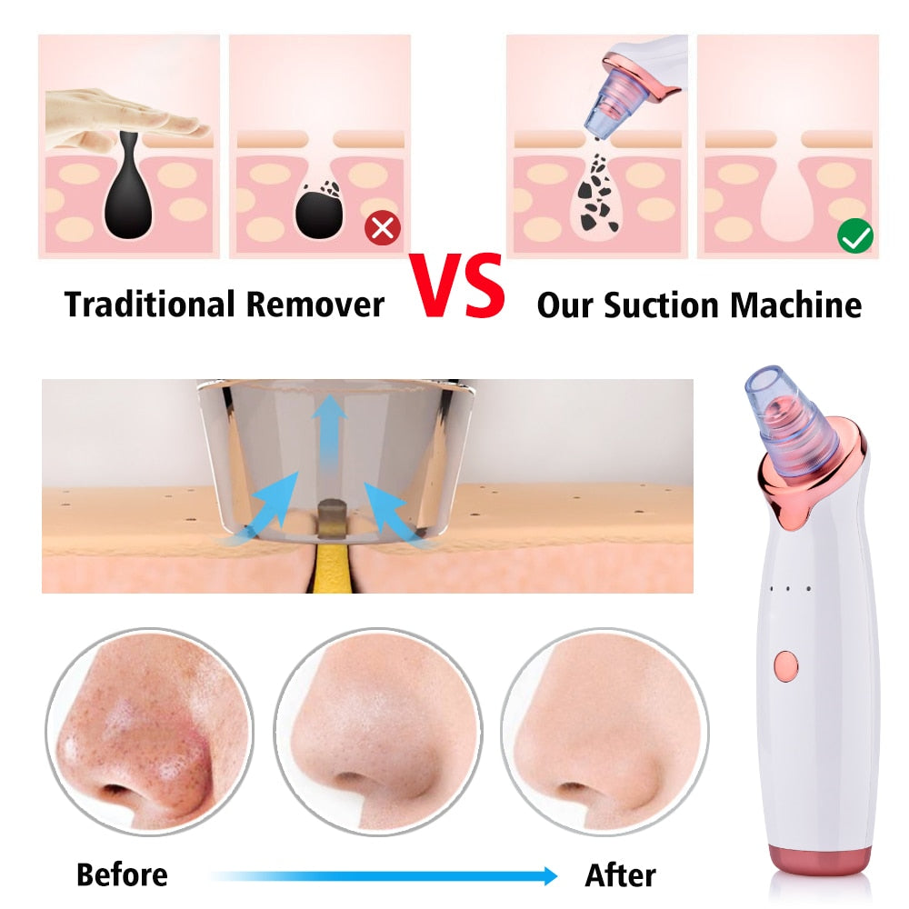 Microcrystailline Blackhead Removal Instrument Electric Suction, Face Wash, Acne Removal Device