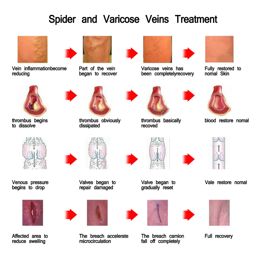 JAYSUNG Varicose Vein Cream - Buy 3, Pay For 2