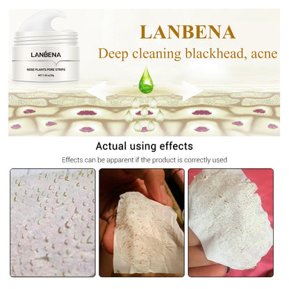 LANBENA Nose and Facial Acne and Blackhead Elimination Liquid and Patch