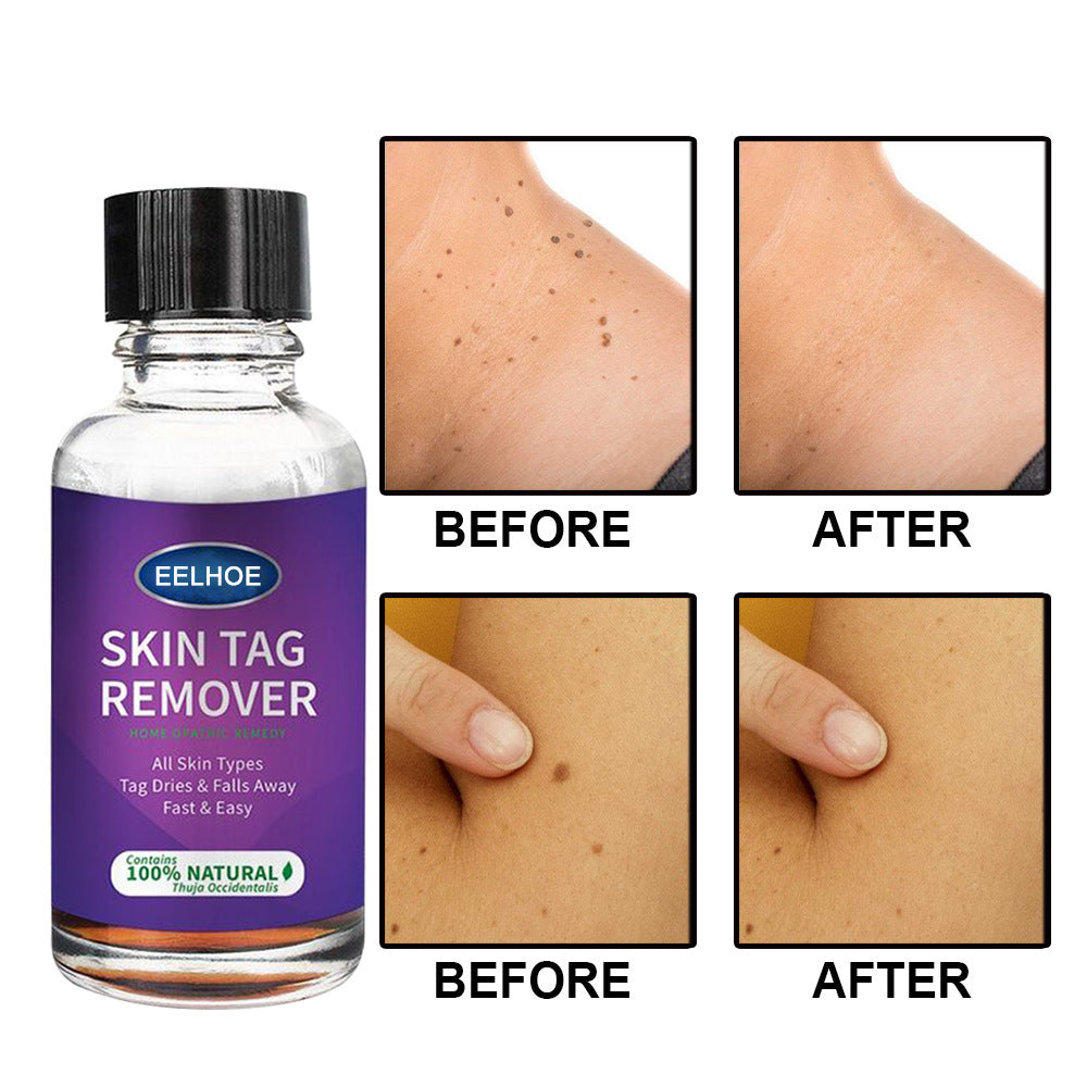 Eelhoe Skin Verrucous Remover To Solve Skin Verrucous