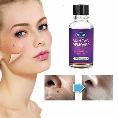 Eelhoe Skin Verrucous Remover To Solve Skin Verrucous