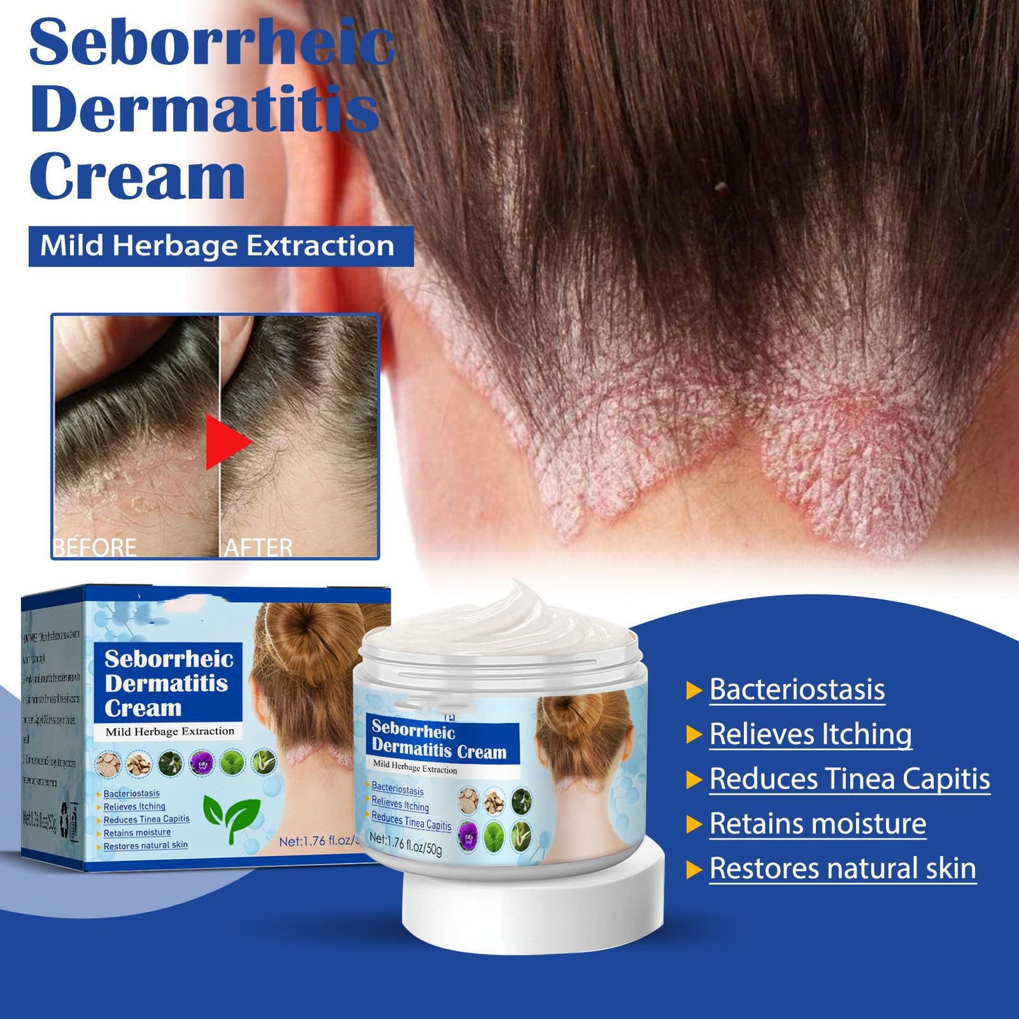 Seborrheic Dermatitis Cream for Head Acne, Hair Loss, and Itch Relief