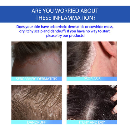 Seborrheic Dermatitis Cream for Head Acne, Hair Loss, and Itch Relief