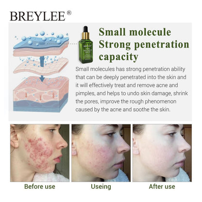 BREYLEE Acne Treatment Serum - Anti Acne Scar Removal Cream Skin Care Whitening Repair Acne Remover