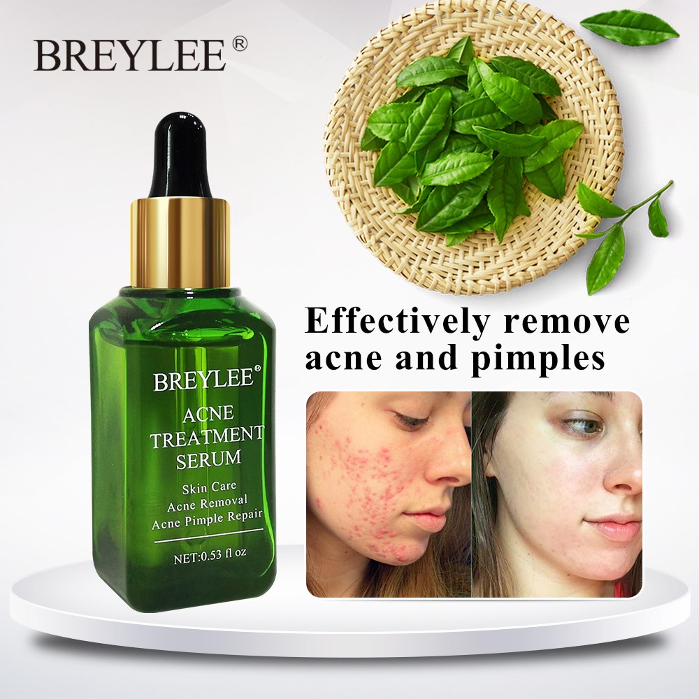 BREYLEE Acne Treatment Serum - Anti Acne Scar Removal Cream Skin Care Whitening Repair Acne Remover