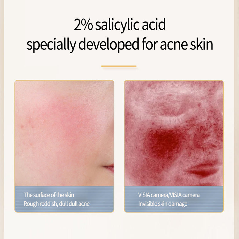 KANSIYI Acne Relief Salicylate Serum