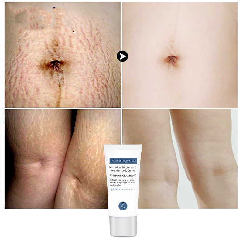 VIBRANT GLAMOUR Pregnancy & Postpartum Stretch Mark Repair and Skin Blemish Removal Cream