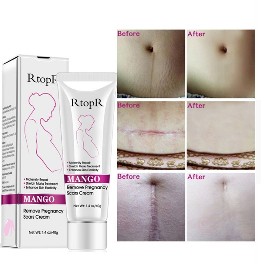 RtopR Mango Stretch Mark Removal and Skin Repair Cream