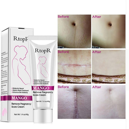 RtopR Mango Stretch Mark Removal and Skin Repair Cream