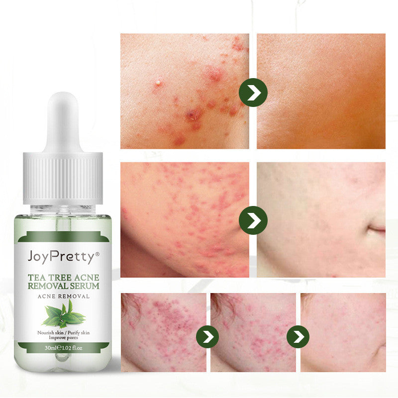 JoyPretty Tea Tree Care Cream that Fade Pimples and Acne Scars