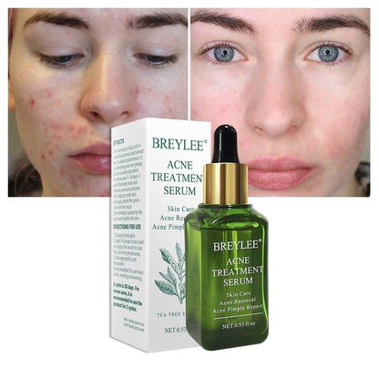 BREYLEE Acne Treatment Serum - Anti Acne Scar Removal Cream Skin Care Whitening Repair Acne Remover