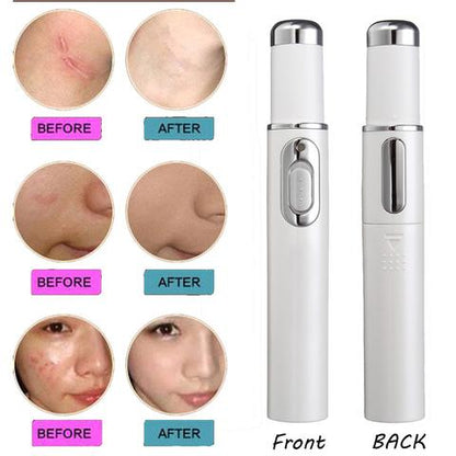 Blue Light Blue Light Therapy Acne Laser Pen, Wrinkle Removal Device