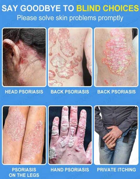 P0ZANIS Psoriasis Treatment Cream – Say goodbye to itching, rejuvenate your skin, dryness, and ulcers, and restore skin vitality.