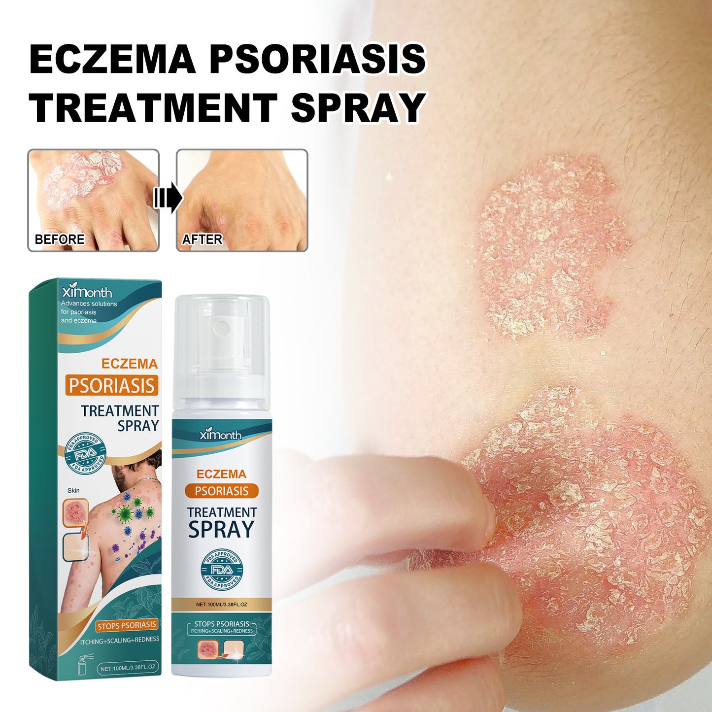 XIMONTH Eczema and Psoriasis Treatment, Redness and Itch Relief Skin Repair Algae Spray