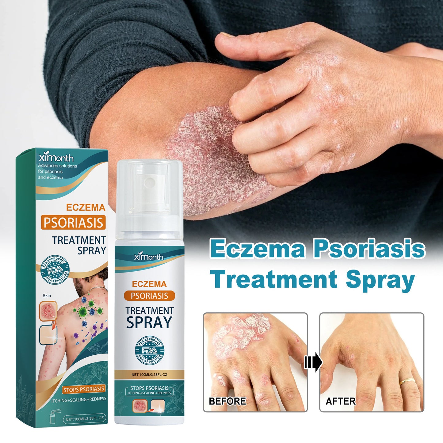 XIMONTH Eczema and Psoriasis Treatment, Redness and Itch Relief Skin Repair Algae Spray