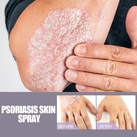 Spray hidratante natural para el cuidado del eczema, la psoriasis y la picazón EELHOE