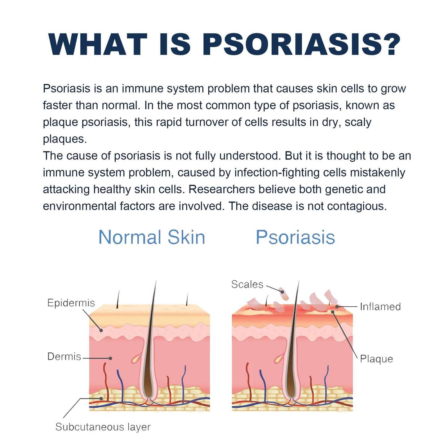 Spray para aliviar la psoriasis de KENANLAN, tratamiento contra el sarpullido y el enrojecimiento