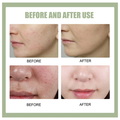 EELHOE Blemish, Acne, Pimple and Blackhead Gel