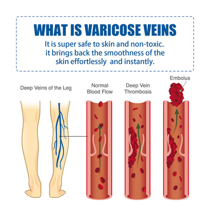 Intravenous Massage Cream Relieves Vascular Leg Massage Treatment and Laser Pointer